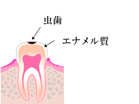 虫歯の進み方