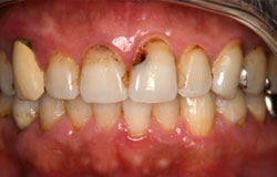 虫歯の症例